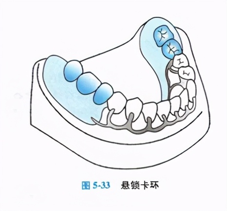 牙列缺损的可摘局部义齿修复题库,牙科美学修复精讲