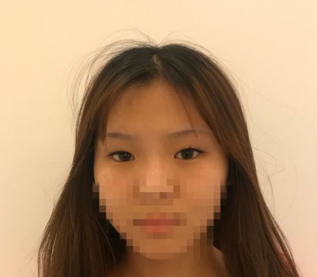 医生说我不适合做线雕,医生说我不适合做飞秒手术