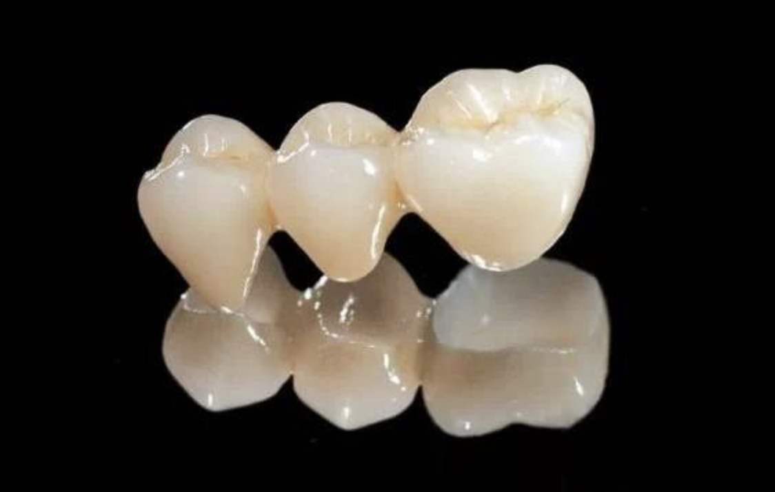 全瓷牙到底比烤瓷牙好在哪,全瓷牙比烤瓷牙哪个更容易崩瓷