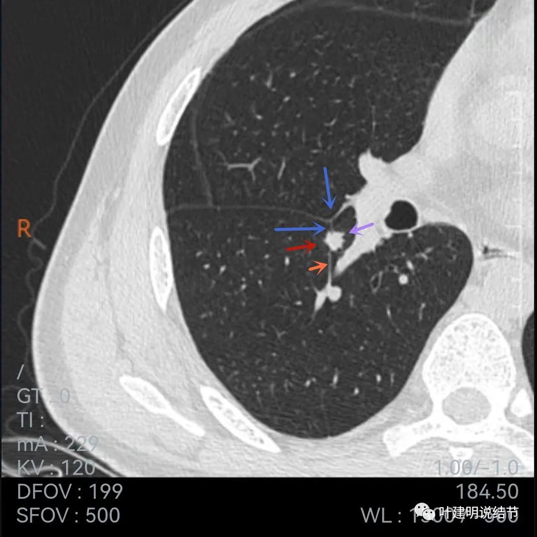 问诊分析:存在了4年的实性结节会不会是肺癌?