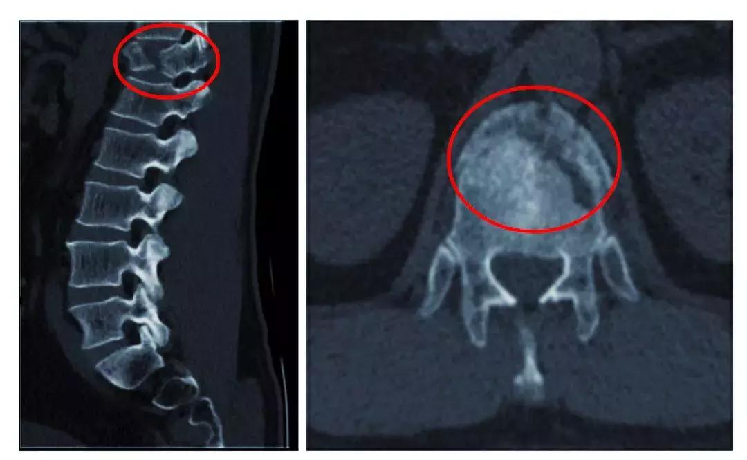 公交司机48岁腰背疼痛怎么回事,司机脊椎末端疼痛怎么回事