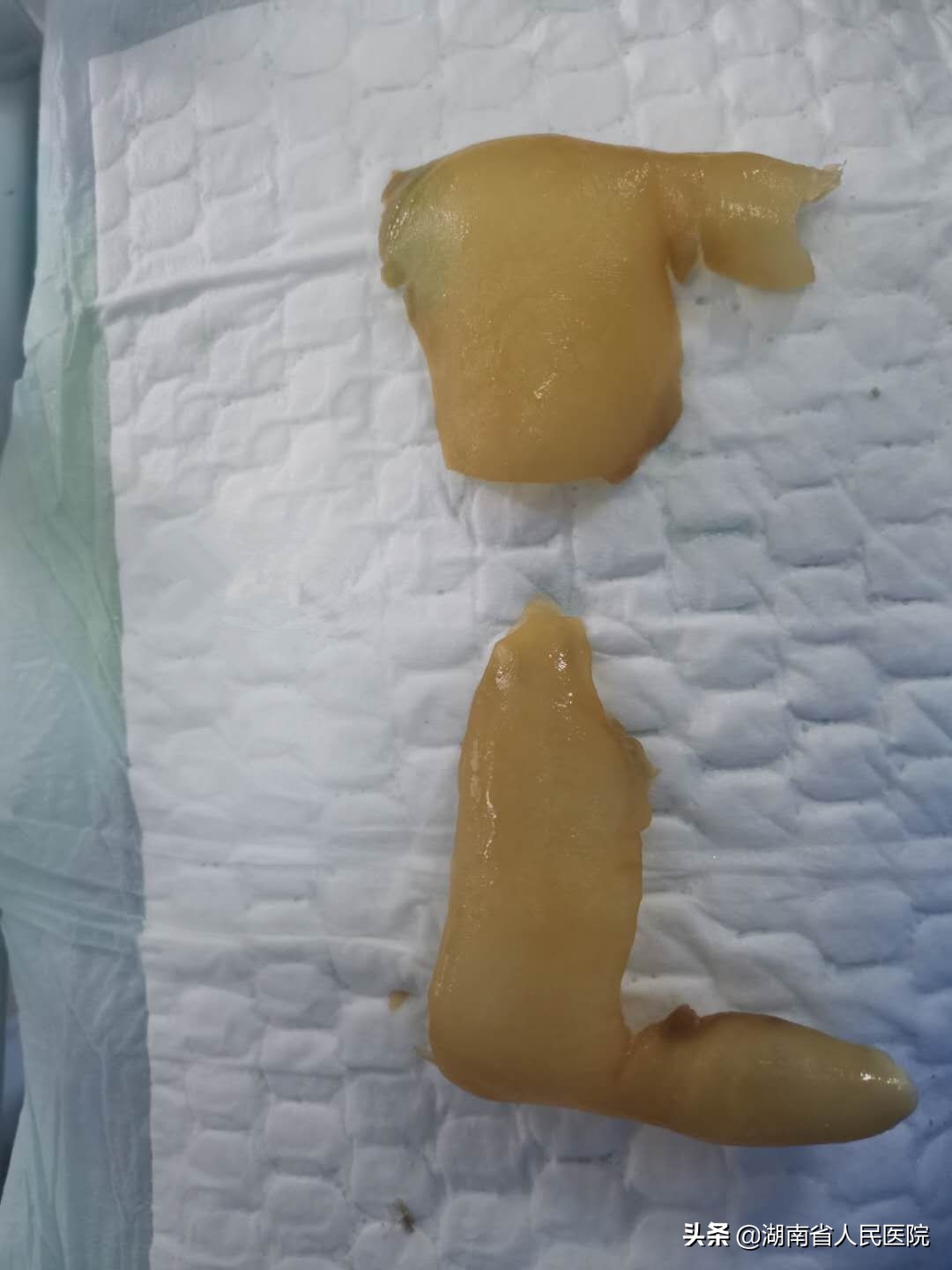 罕见病男孩湖南,罕见病湖南男孩