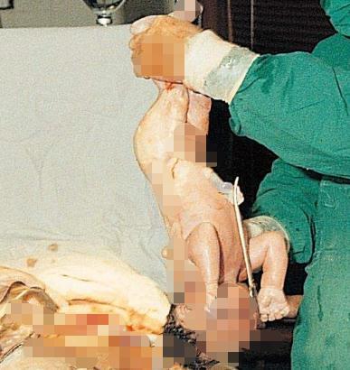 宝宝顺产出生的过程,剖腹产的小孩比顺产的小孩胆小吗