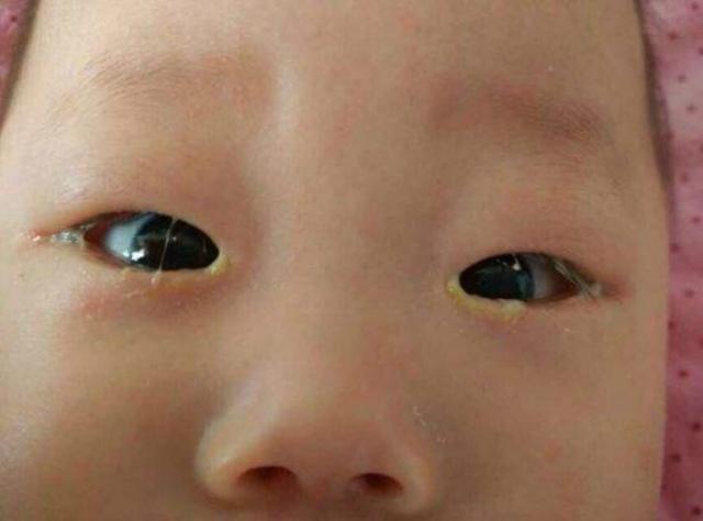 满月婴儿一只眼睛有眼屎流眼泪,刚满月的宝宝一只眼睛总是有眼屎