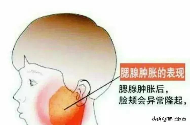 腮帮子肿大的危害,半边脸肿得像猪头是什么病