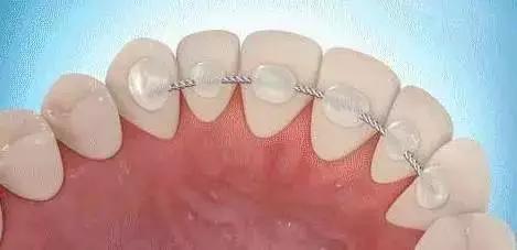 雅悦齿科矫正牙齿好不,上海牙齿矫正保持器要戴多久