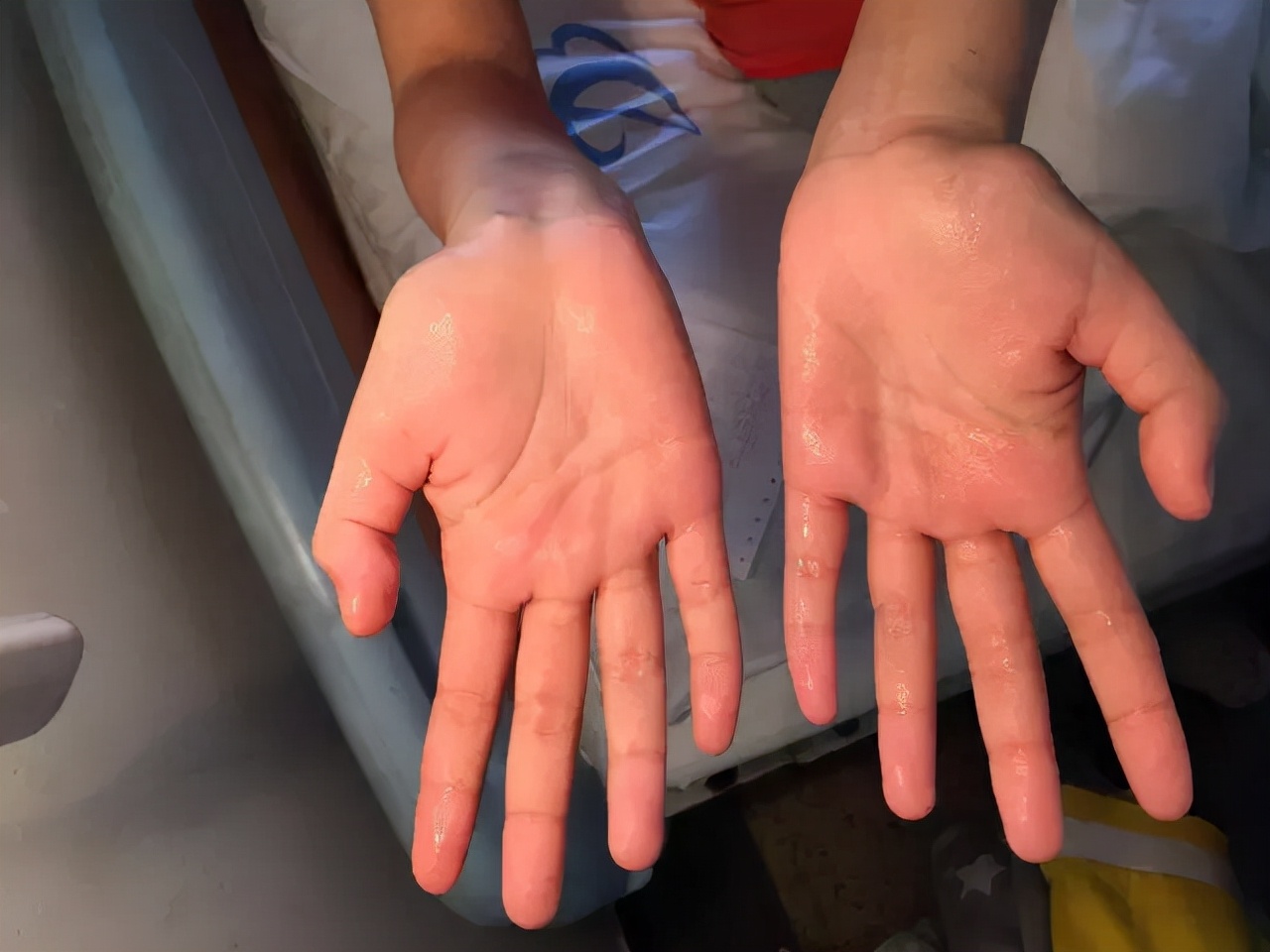 20多年的手汗症终于好了,手汗困扰多年