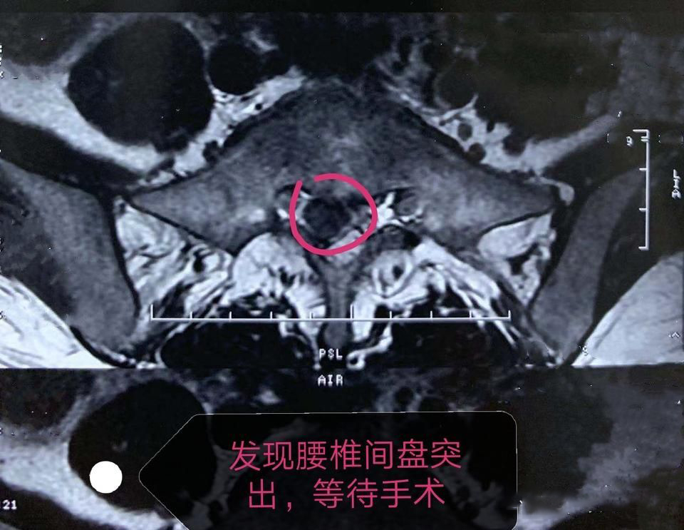 椎间盘突出病案分析,腰椎间盘突出做手术好久恢复正常
