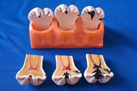 牙齿龋坏究竟要怎么办，补牙之后又能用多久呢？听听看牙医怎么说