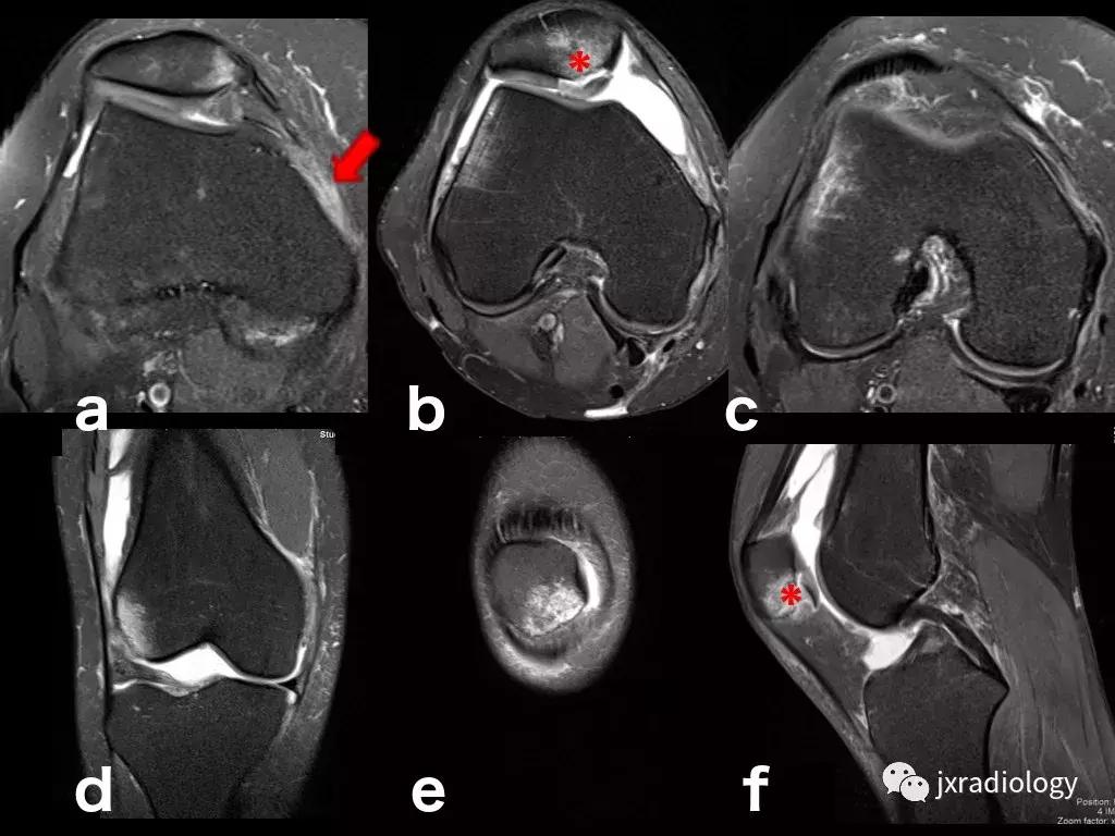 磁共振骶髂关节骨髓水肿是强直吗,磁共振显示骨髓水肿什么意思
