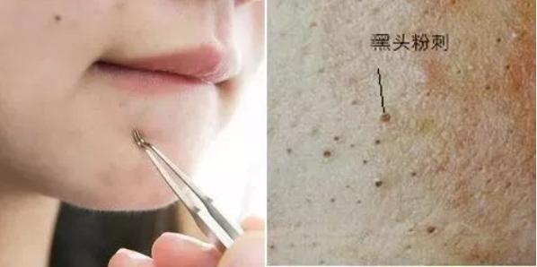 去黑头为什么黑头越来越多,长了黑头到底能不能挤