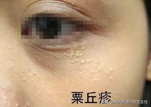 脂肪粒是怎么形成的怎样根除,脂肪粒是怎么形成的怎么处理