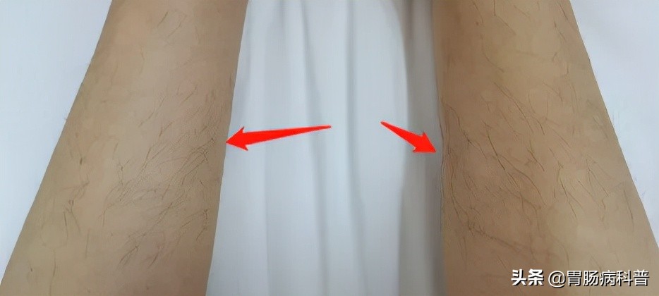 七十岁老太太腿部长了个肉疙瘩,70岁老太太患上了癌症