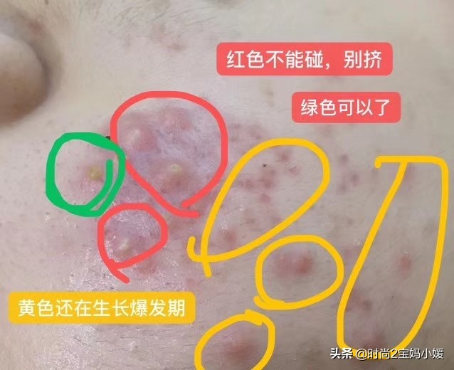 长痘痘不要怕祛痘有良方,长痘痘了该如何消痘不用任何药品
