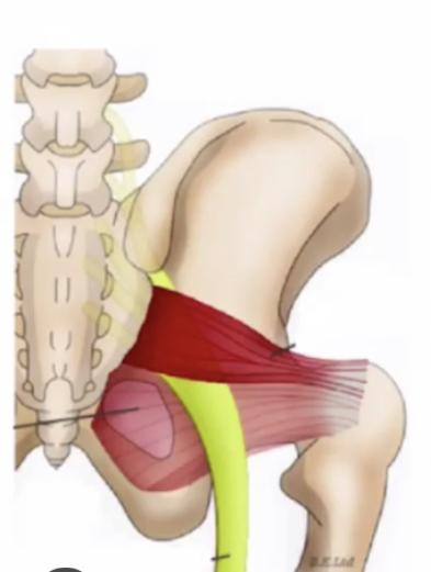 压到坐骨神经怎么缓解,坐骨神经痛吊单杠缓解