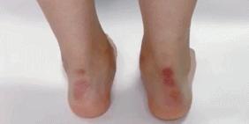 运动防止起水泡,预防长时间走路起水泡