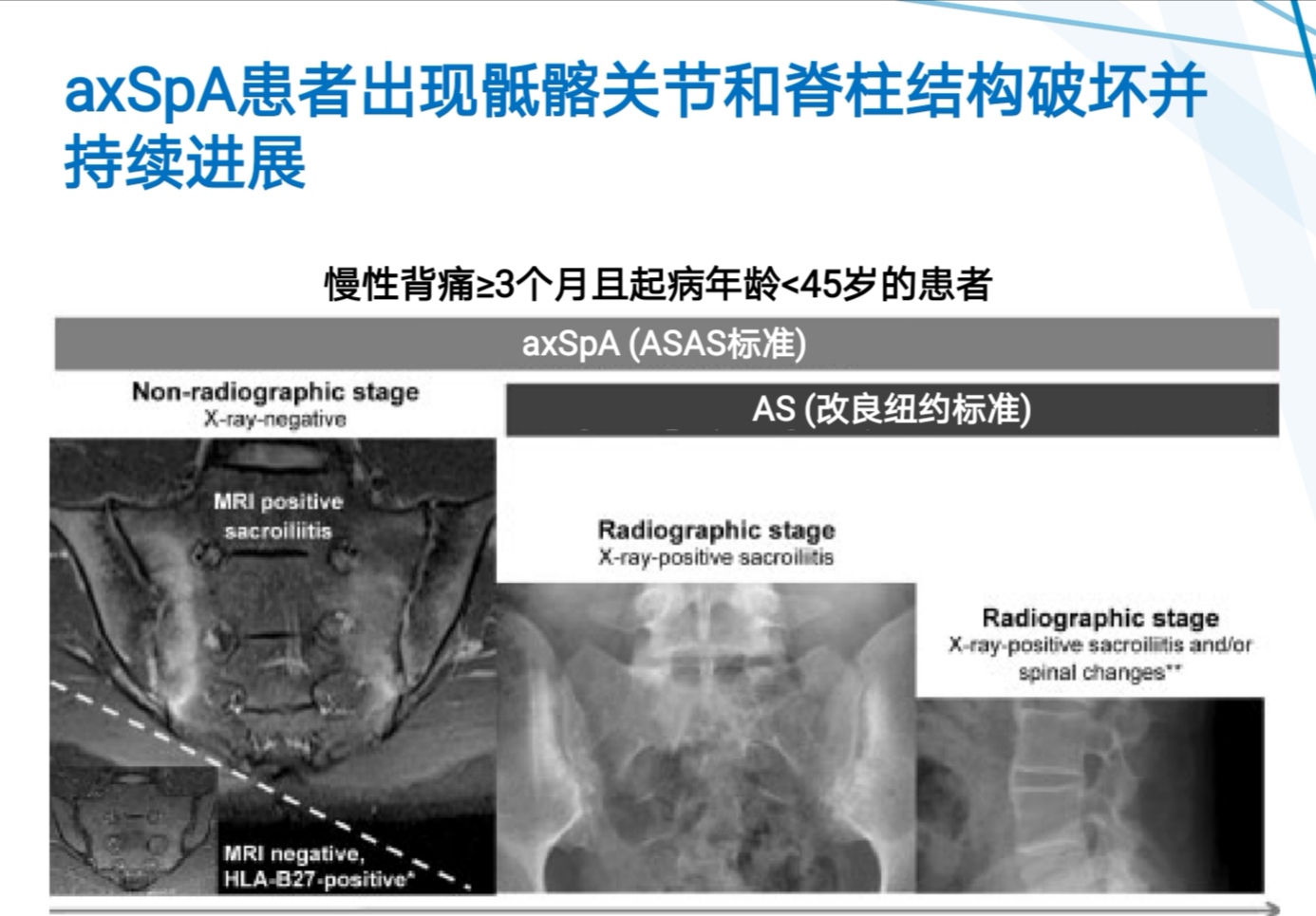 强直性脊柱炎生物制剂影响怀孕吗,强直性脊柱炎什么时候用生物制剂