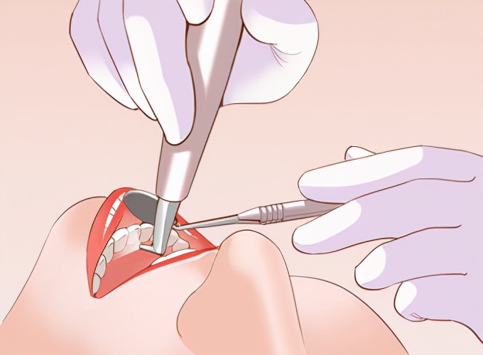 种植牙成为牙齿修复的最佳选择,种植牙是牙齿修复的最佳选择吗