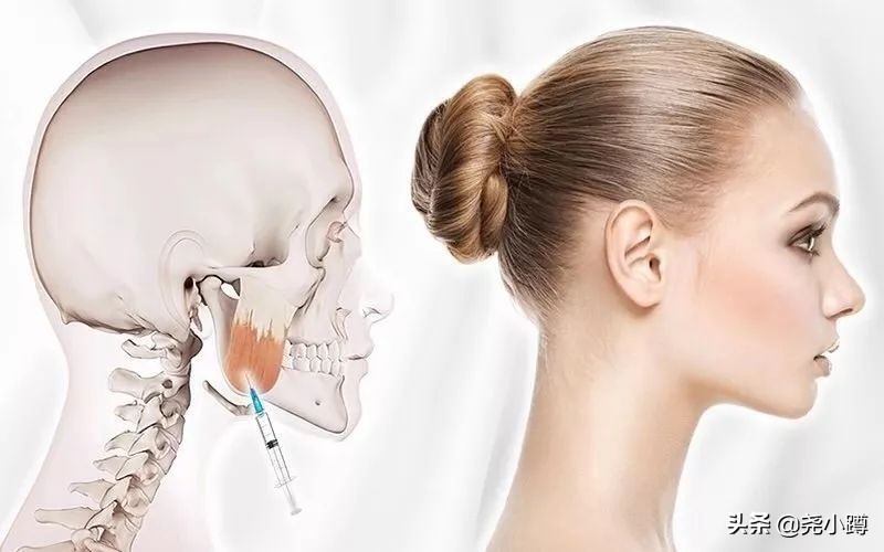 瘦脸针的科普,瘦脸针知识普及