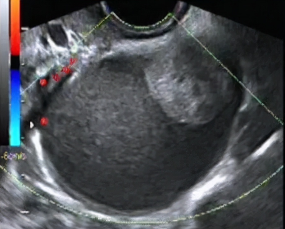 生完娃体检出现卵巢囊肿,卵巢囊肿可以通过教育局体检吗