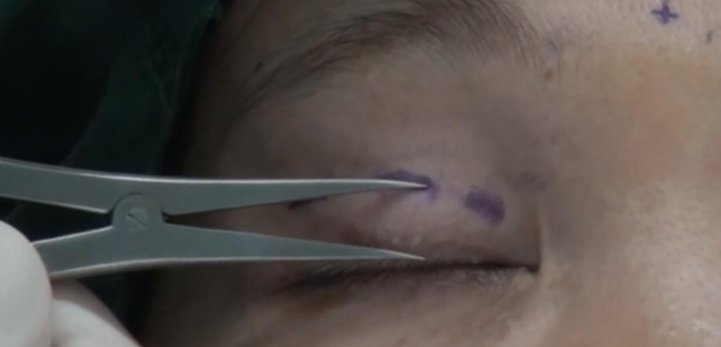 双眼皮科普小课堂:双眼皮的三种术式及术后护理