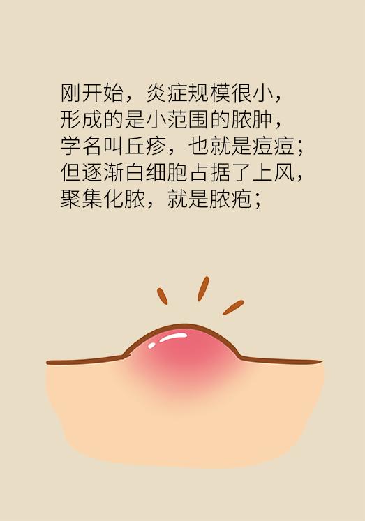 协和医院教你祛痘,长痘别着急中医祛痘秘方来帮你