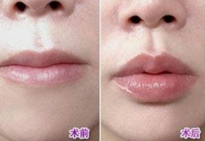 唇部美学图解,唇部美容的方法