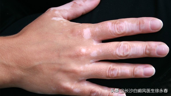 白癜风需要忌口吗,白癜风需要忌酒么