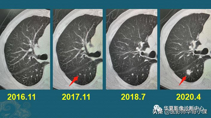小细胞肺癌早期ct表现为什么结节,肺部ct显示有三处2cm结节是肺癌么