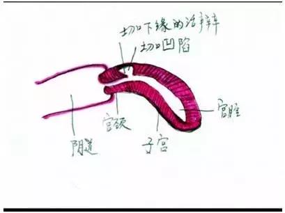 子宫憩室后遗症有哪些,子宫憩室手术治疗有哪些危害