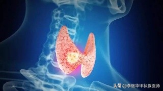 砂粒样钙化是什么意思,钙化结节和肿瘤结节区别