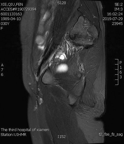 「不死的癌症」之克星——子宫腺肌症介入栓塞治疗