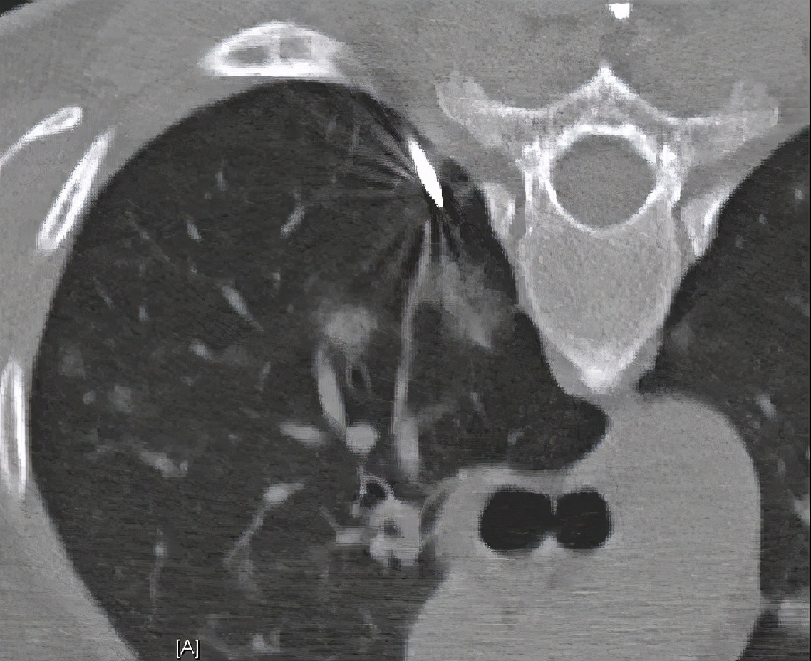 机化性肺炎必须病理确诊吗,机化性肺炎好转的征兆