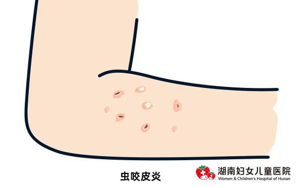 小孩夏天怎么防止痒疹,夏天的宝宝怎么避免热疹