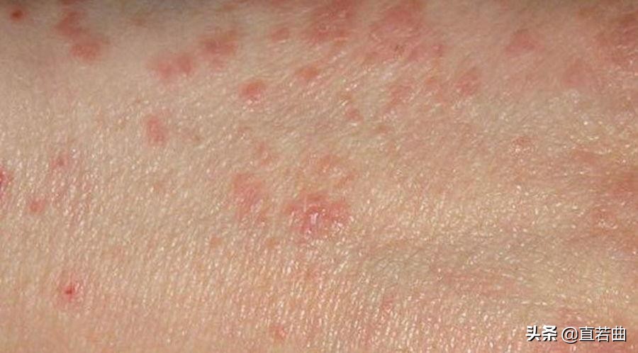 脸上螨虫过敏怎么办,脸上螨虫过敏怎么解决