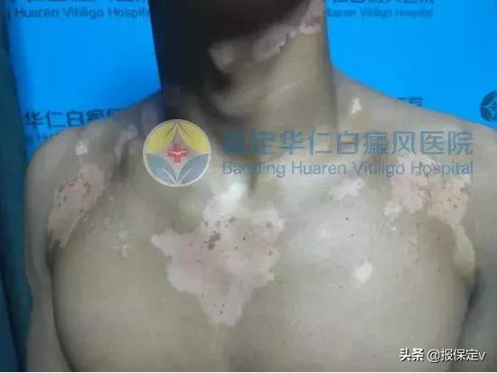 困难退役军人家庭先心病子女救助,退役军人优医救助