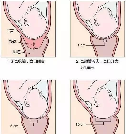 顺产是疼痛的最高级别吗,顺产最疼的是不是开宫口