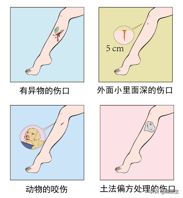 破伤风危及生命,破伤风什么情况需要打针