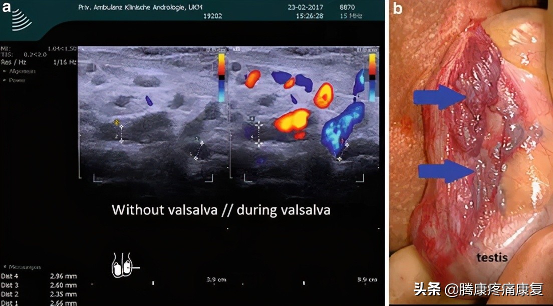 男性不育精索静脉曲张好治吗,精索静脉曲张性男性不育诊断标准