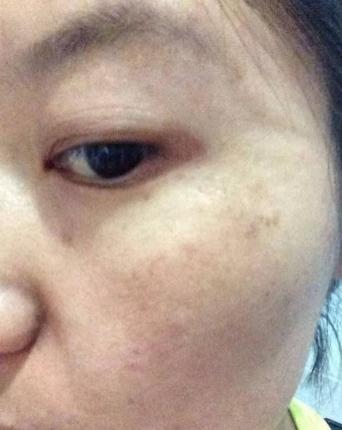 女人脸上有斑点是怎么回事,50岁女人脸上有斑点怎么消除