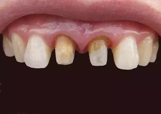 烤瓷牙金属露出来了有毒吗,烤瓷牙内部金属有毒吗