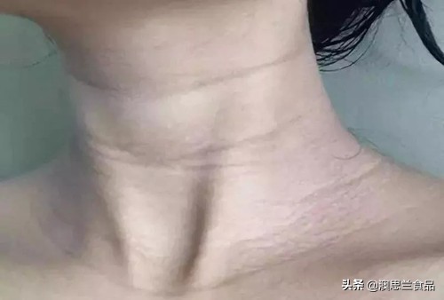 懒人最简单快速的去颈纹方法,颈纹难看去不掉试试这个方法