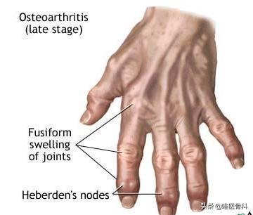 手指僵硬骨关节炎的治疗,手指关节肿大是骨关节炎能治好吗