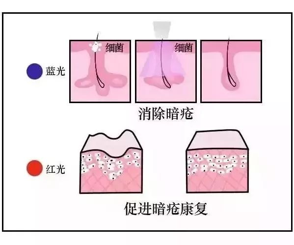 红蓝光祛痘对比图,库博士祛痘效果怎么样