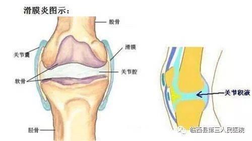 骨科膝盖积液,骨科积水怎么办