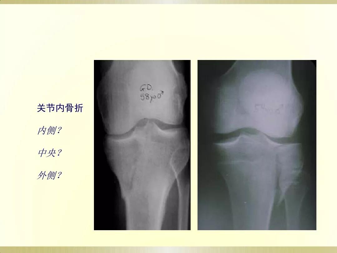 骨科x光片读片技巧,放射科骨科读片教程