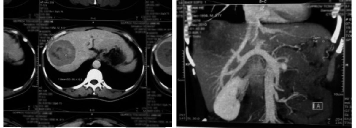 肝癌介入tace术后有什么副作用,肝癌介入治疗后副作用大不大