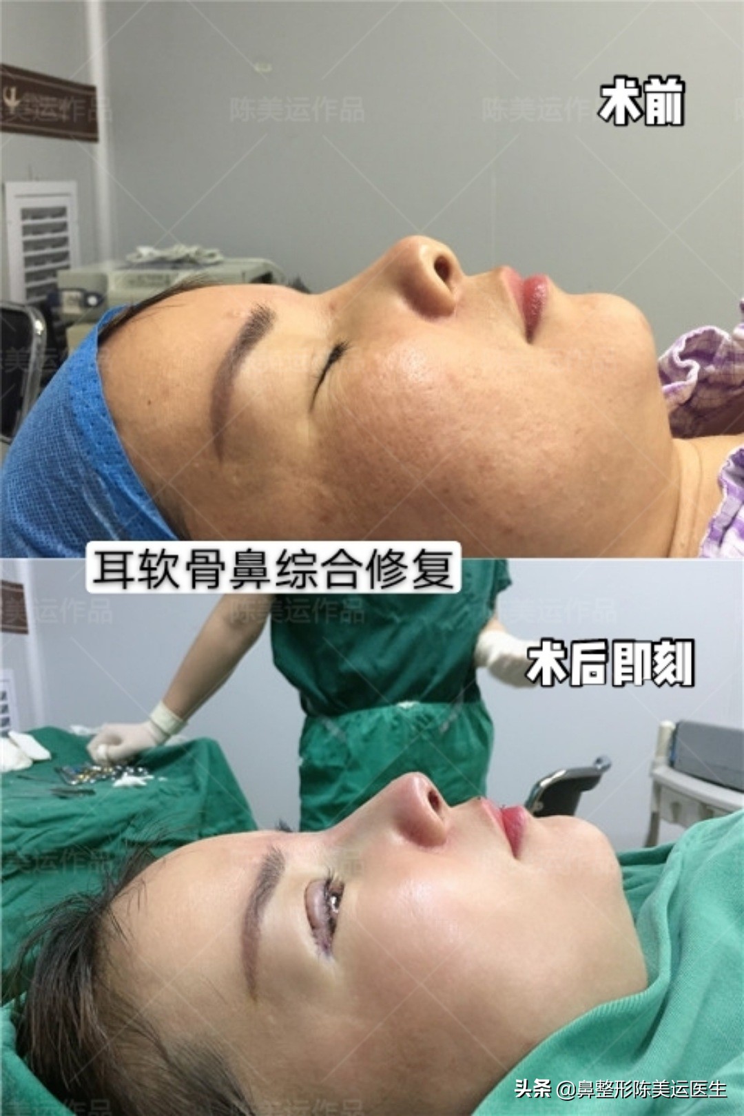 假体隆鼻后鼻子变歪该如何处理,假体隆鼻透光如何处理