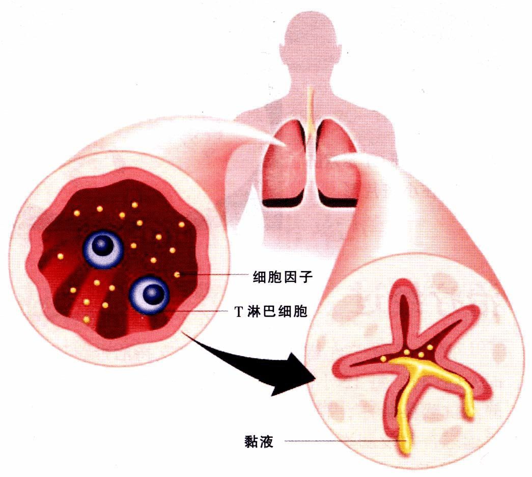 支气管哮喘健康宣教,哮喘健康指导内容有哪些