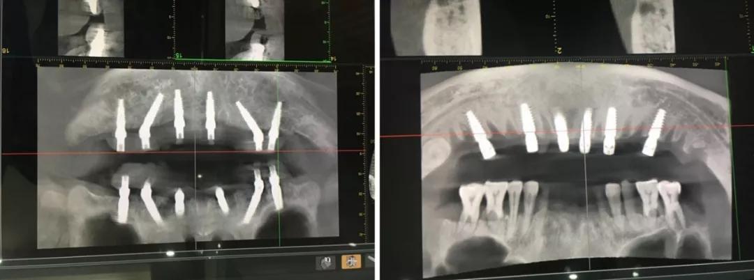 日照口腔牙齿矫正费用,日照牙科修牙多少钱一颗